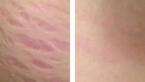 photo avant/ après travail sur vergetures cuisse