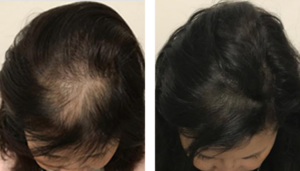 photo avant/après d'une tricopigmentation / redensification sur femme aux cheveux brun