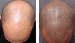 photo avant/après d'une tricopigmentation sur homme effet crâne rasé