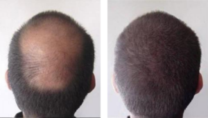 photo avant/après d'une tricopigmentation / redensification sur homme