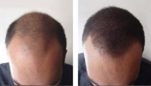 photo avant/après d'une tricopigmentation/ redensification sur homme