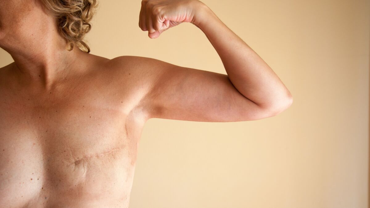 photo d'une femme ayant eu une mastectomie